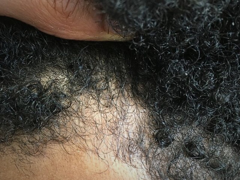 Free scalp analysis